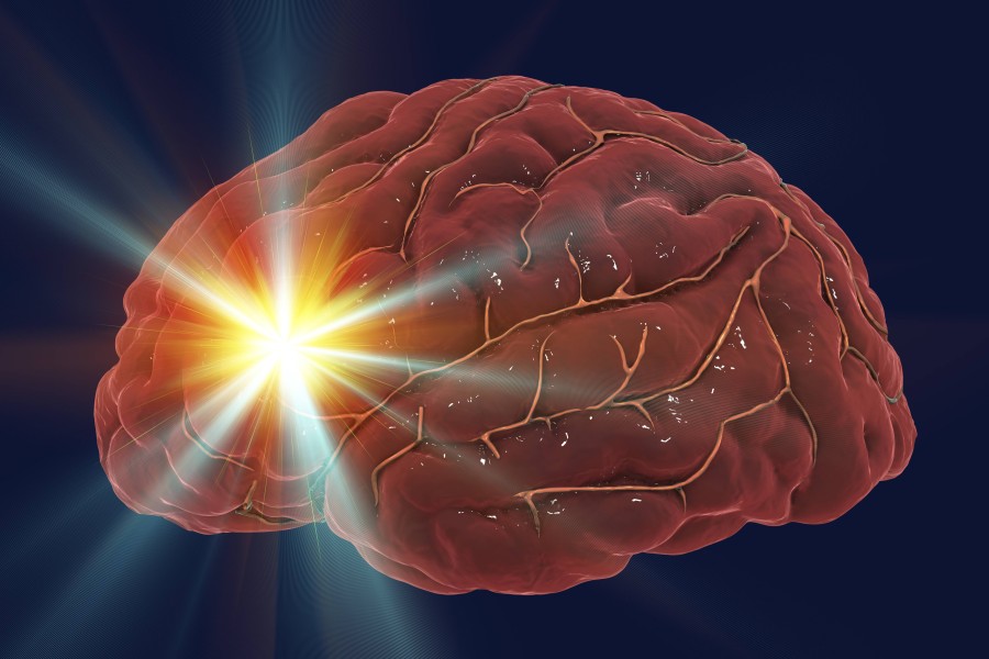 Der Schlaganfall (Apoplex, Hirnschlag) ist eine plötzliche Durchblutungsstörung im Gehirn. (Symbolbild)