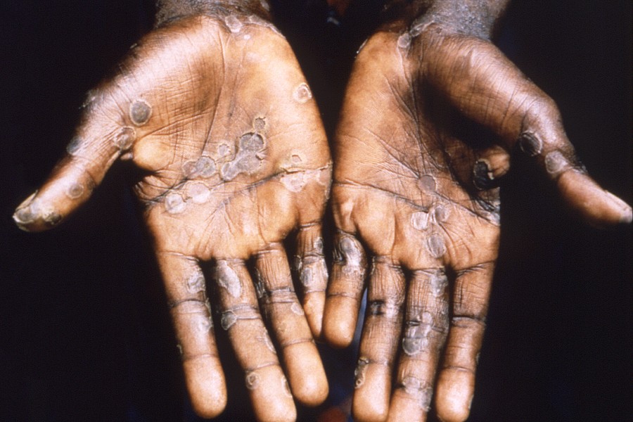 Dieses Bild aus dem Jahr 1997 entstand während einer Untersuchung eines Affenpocken-Ausbruchs in der Demokratischen Republik Kongo. 